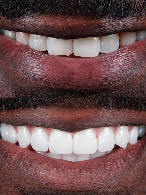Advanced Dental Whitening