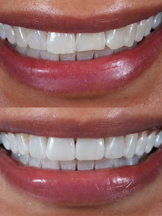Advanced Dental Whitening