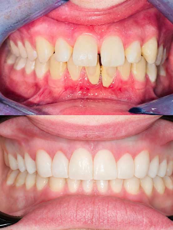 Advanced Dental Whitening