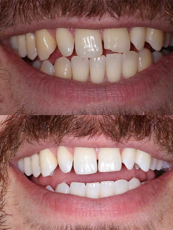 Advanced Dental Whitening